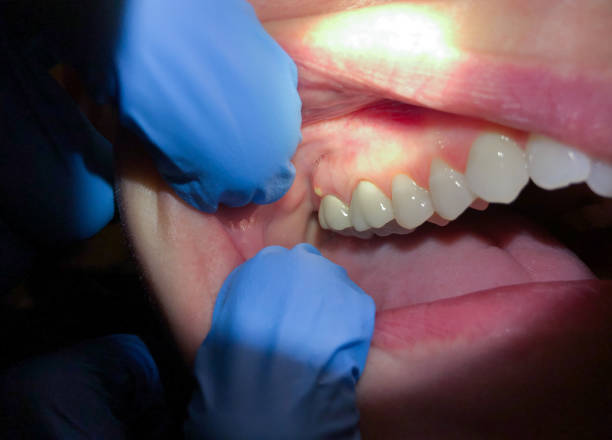 Best Emergency Root Canal Treatment in Cleveland, TX
